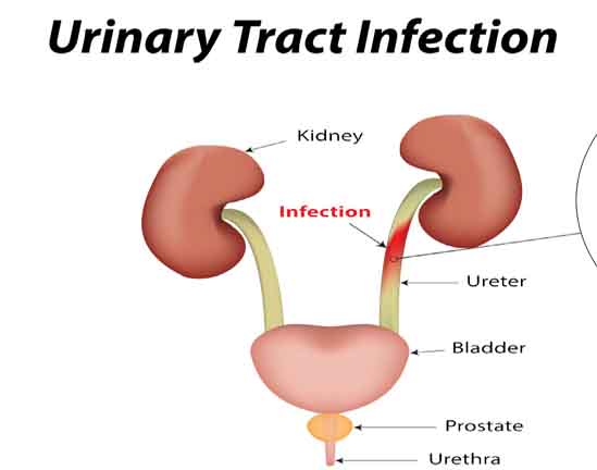 Your clothes can spike chances of UTI - The Shillong Times