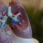 lung cancer